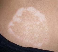 防止白癜风复发要注意哪些